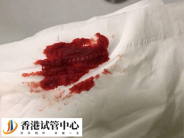 胚胎移植5天出血可能是先兆流產