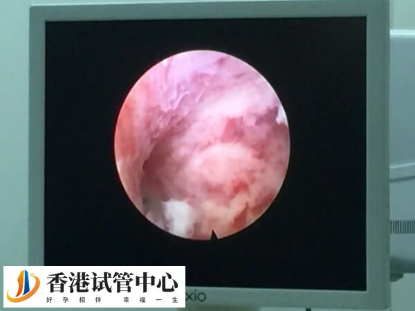 反復IVF移植失敗可以做宮腔鏡檢查