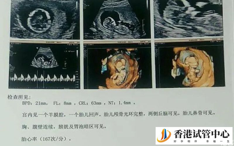 nt檢查用于判斷胚胎發育情況