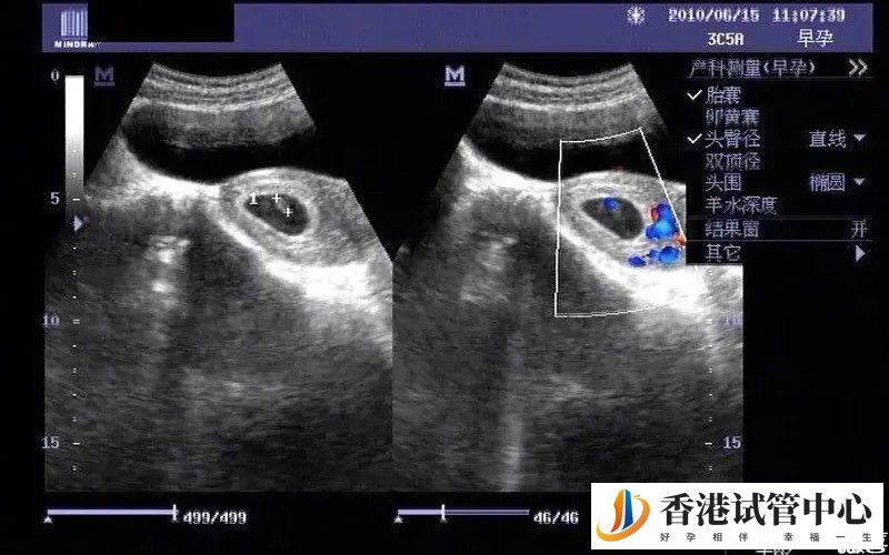 胎兒B超檢查報告