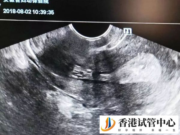 人工周期移植日可不可以推后一天