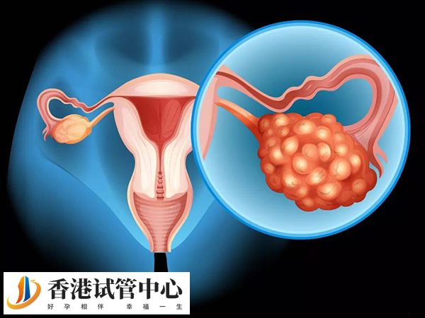試管取卵后可能會(huì)卵巢過(guò)度刺激