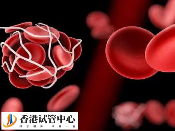 彈力襪可以幫助預防深靜脈血栓